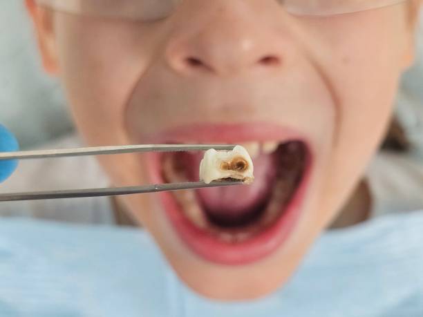 Best Emergency Dental Extractions in Perry, IA